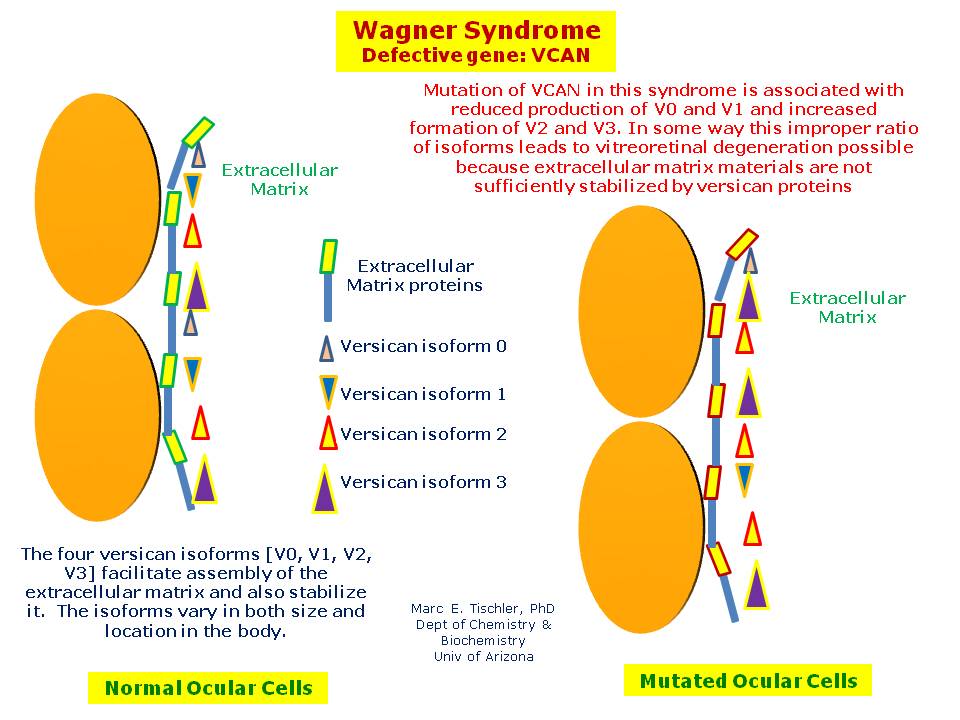 What Is The Wagner Disease Of The Eye? Understanding This Rare Condition